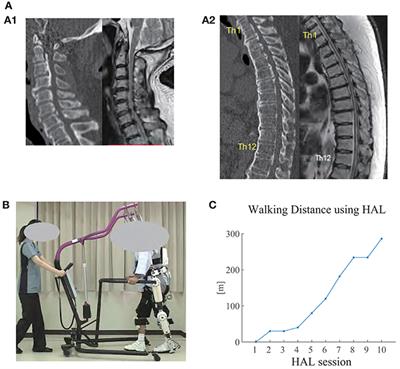 Muscular Activity Modulation During Post-operative Walking With Hybrid Assistive Limb (HAL) in a Patient With Thoracic Myelopathy Due to Ossification of Posterior Longitudinal Ligament: A Case Report